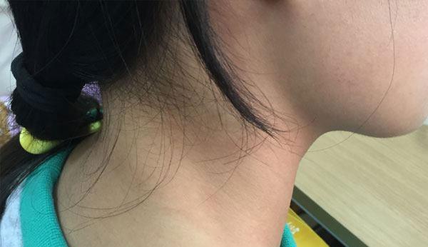 【淋巴癌】为什么淋巴癌患者增多？这3点可能是主要原因，不容忽视！