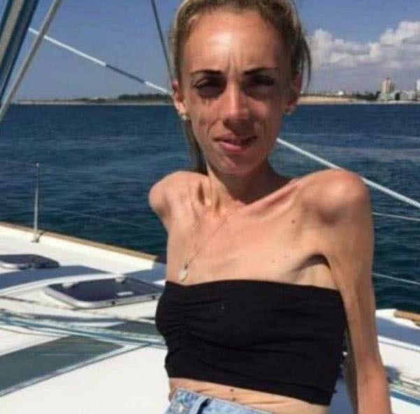 运动|女子减肥上瘾瘦成了皮包骨，现只剩54斤，减肥方法我服了