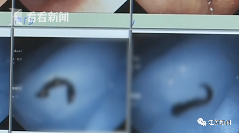 芒果都市|惊悚!5岁男孩气管内发现活体蚂蟥,还存活了一年多!