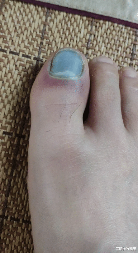 美甲|“脚趾被钢管砸了，有什么办法好的快？”哈哈哈新做的美甲？