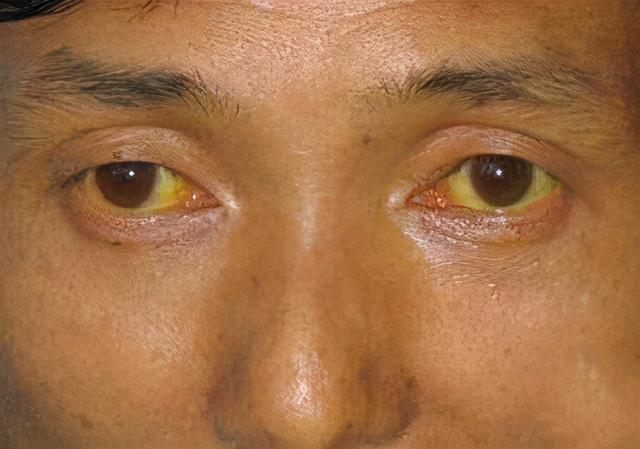 肝脏|37岁男子眼黄入院，确诊肝癌，医生：身体早有提示，怪他不重视