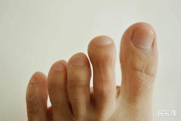 肝脏|脚是人体“报警器”？反复出现3个异常，肝可能伤得不轻