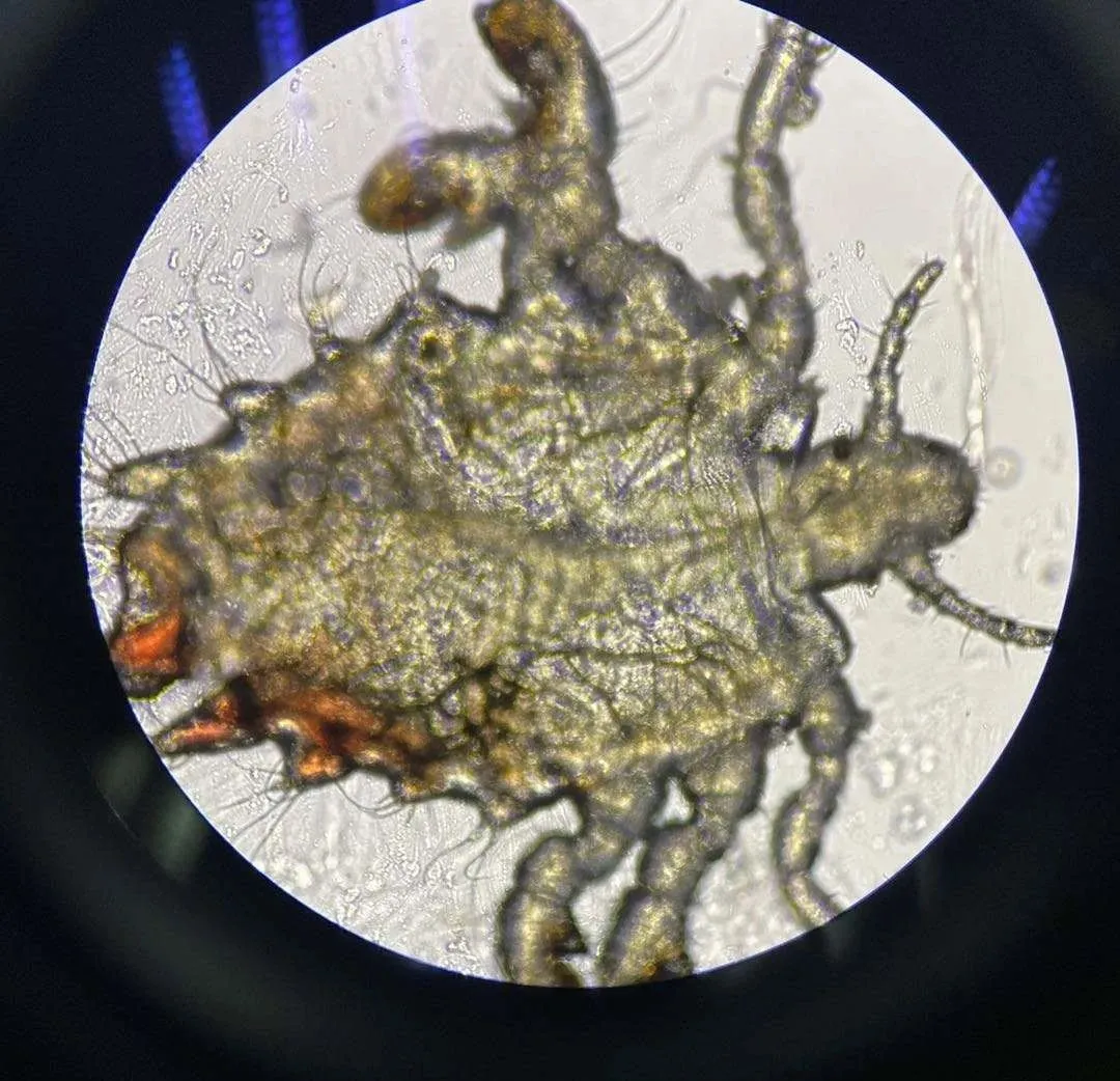 半岛晨报|两岁男童眼睛里取出多只虱子，还在动！