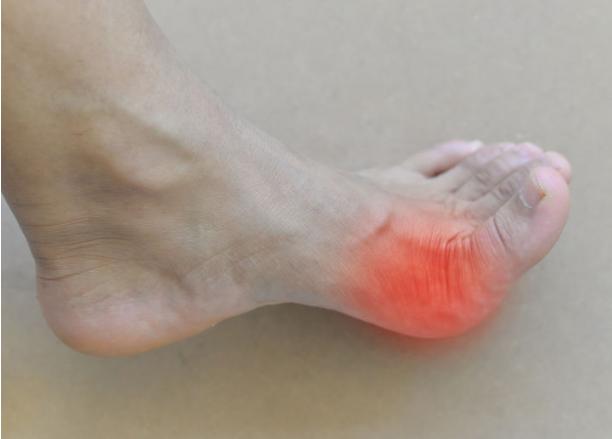 痛风|从不喝酒也不常吃海鲜，却被痛风折磨很惨？厨房“四味”或是元凶