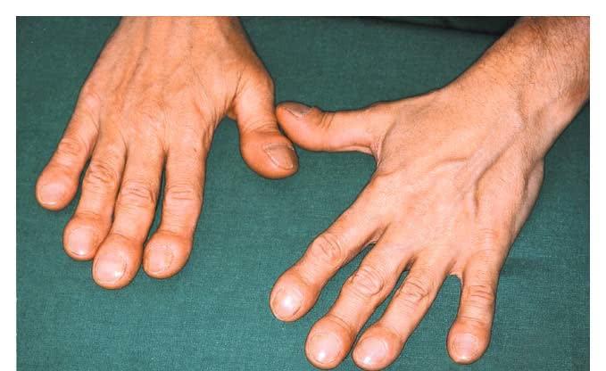 肺癌▲我国每年80万人患上肺癌，身上有4处“变大”，一定要重视