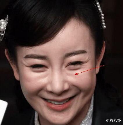 「整容」被玻尿酸毁了的六大女星，王心凌像老太太，而她丑到不可接受