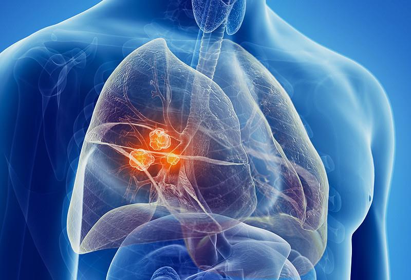 肺癌▲我国每年80万人患上肺癌，身上有4处“变大”，一定要重视