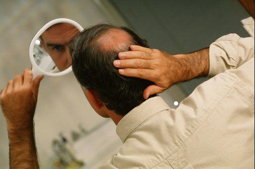 #脱发#男性出现脱发现象的原因是那些？