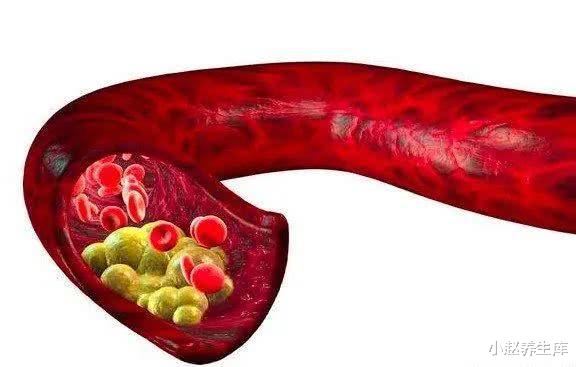 『高血脂』提醒：四个信号出现，说明血脂高了，哪怕有一个，也去检查一下！