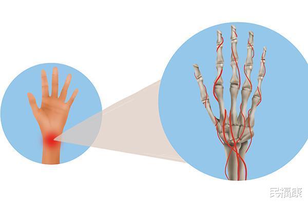 肺癌|陪同看病反被发现有肺癌，手部的癌症信号有哪些？可能还是早期！
