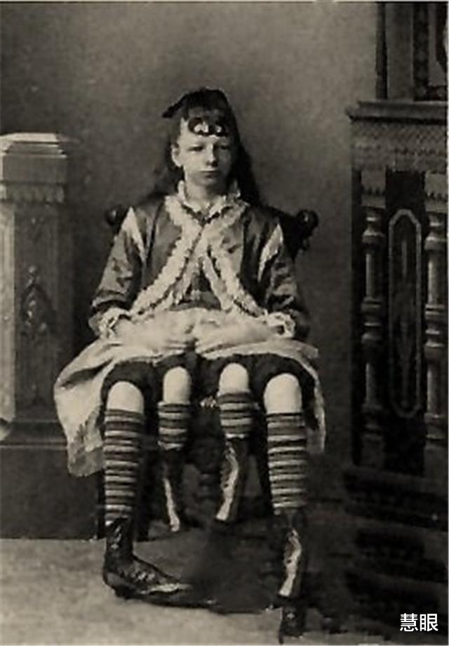 :人类历史上9大怪胎:世界上真是存在的变异人