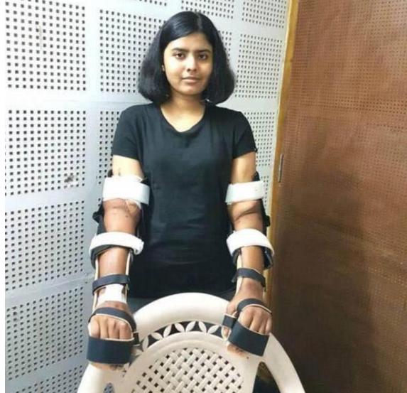 印度女孩雙手截肢後，移植黑人男子手臂，兩年後全身皮膚開始變黑-圖3