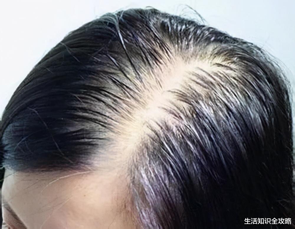 洗发水|头发越洗越少，可能是你洗发水出问题，满头头屑原来是这种原因