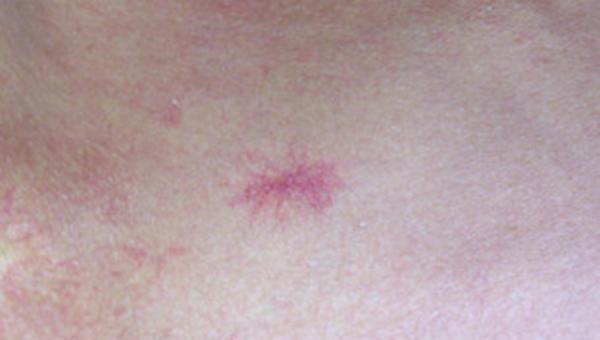 肝脏|肝一病，痣就多？如果身上长出2种痣，可能肝癌到访，早查早好