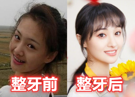 【杨幂】有种差距叫“明星整牙”，郑爽变美，杨幂气质，而她堪比“整容”