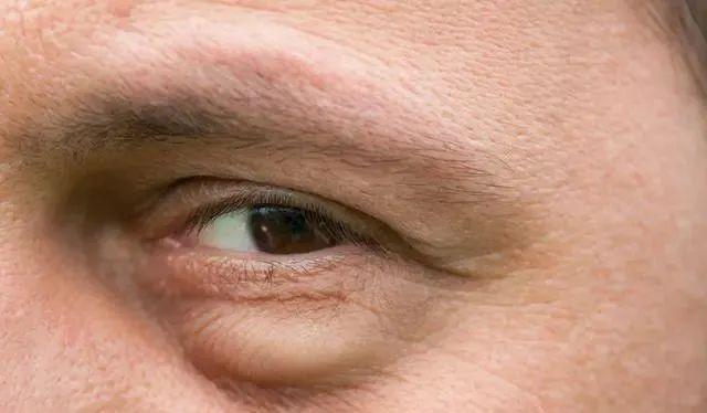 『胆固醇』42岁男子腰疼入院,查出肾衰竭,提醒:餐桌上一道“菜”最好少吃