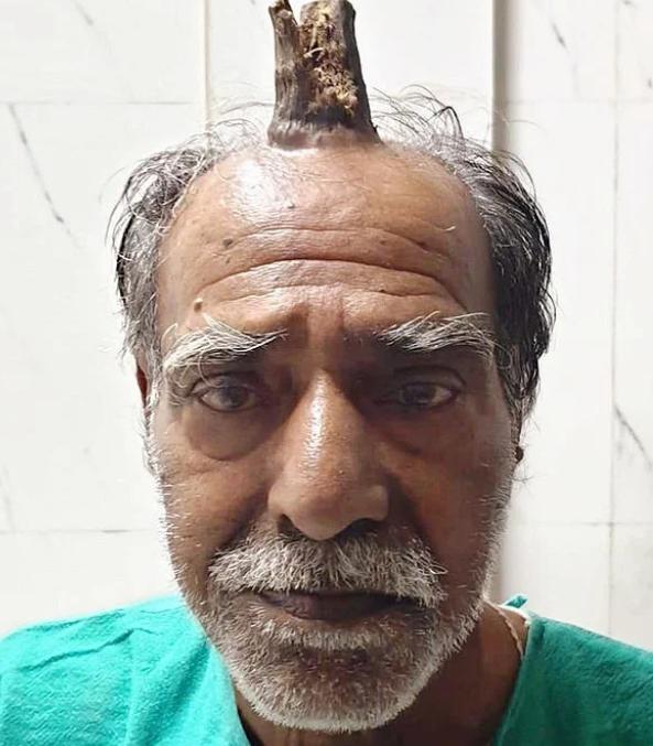 印度75歲男子頭頂長出10厘米“魔鬼之角”，真實版“小龍人”-圖3