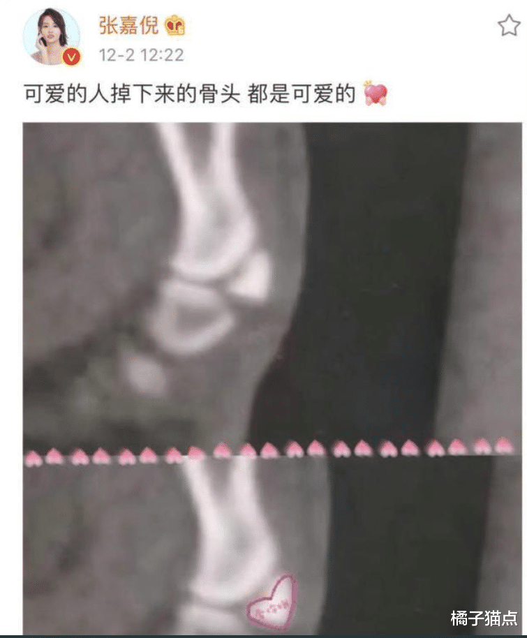 張嘉倪意外受傷，曬照X光片，配文：可愛的人骨頭都是可愛的-圖4