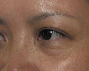 #肝脏#脸上有这四个症状时，可能是肝癌来临的信号，别总是不放心上！