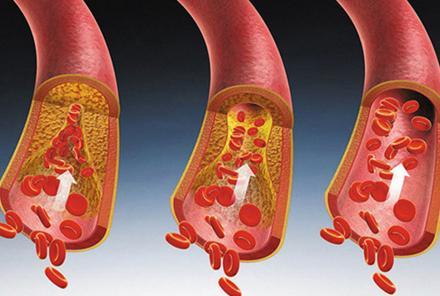 胆固醇|高血脂的天敌被发现，经常泡水喝，血管干净，高血脂不攻自破