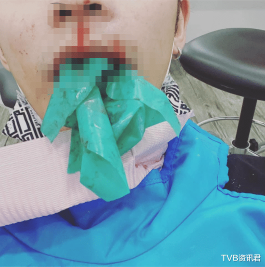 鼻孔下出現大洞！32歲人氣男星緊急入院治療：頭骨已被細菌侵蝕-圖4