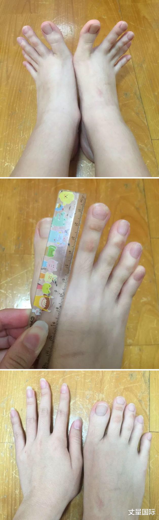 基因|19个“被上帝挑选过”的特殊基因人类，怎么梳都不整齐的头发