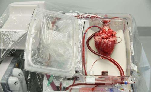 「狒狒」36年前移植狒狒心脏的那个女孩, 最后成功了, 她到底活了多久?