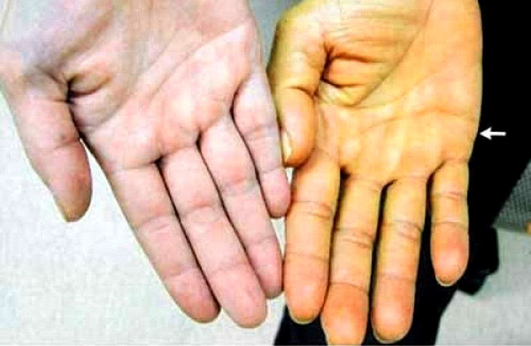 「肝癌」癌症都是拖出来的,身上出现1痛、1热、1黄的信号,尽快查查肝