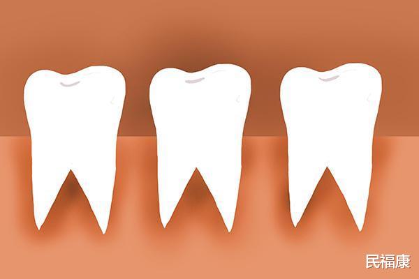 牙齿▲牙缝变大，吃东西塞牙，为何牙缝会越来越大？原因对照一测便知