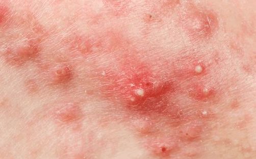 老中医@头皮和后背总是长疙瘩?引起的原因主要有4种,解决的办法全在这