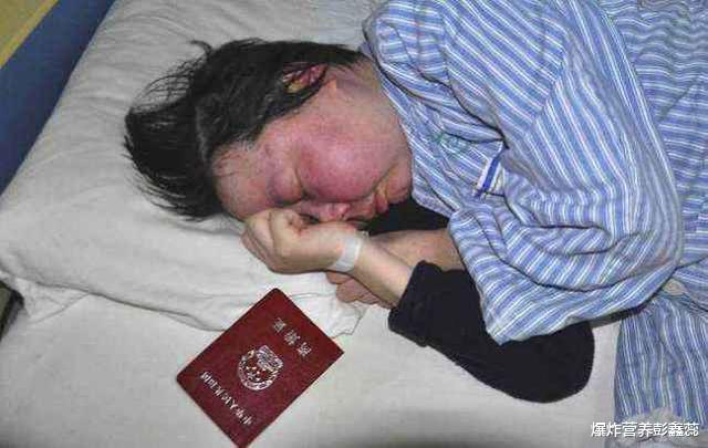 红斑狼疮|偏爱年轻女性、亚洲人的红斑狼疮,出现3种症状,赶紧去医院检查