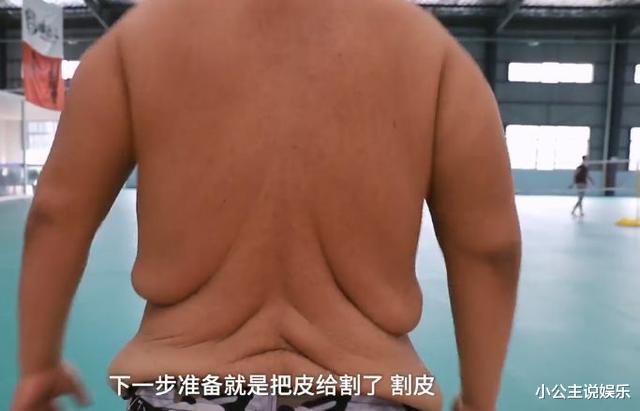 医生|励志！他是中国第一胖，为减肥切胃，并开始锻炼为爱减重400斤