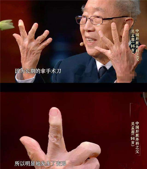 #吴孟超#吴孟超:90多岁每天做3台手术,一根“特殊”手指,令人心生敬意
