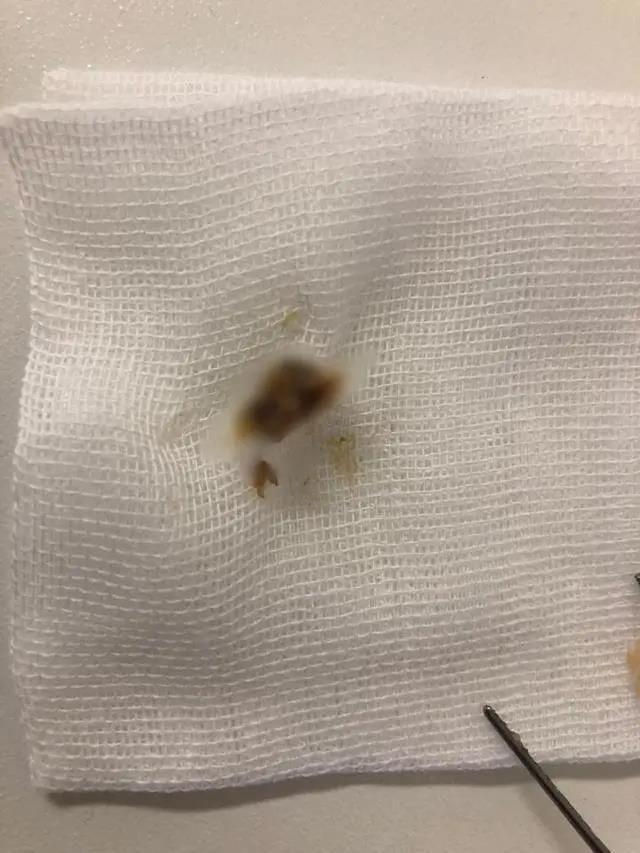 #杭州#杭州姑娘一觉醒来听不见了!医生从她耳朵里挖出一大坨脏东西