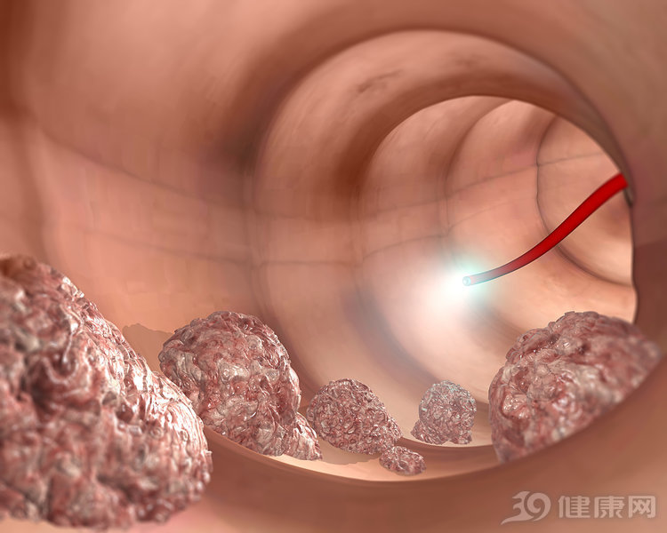 医生|身体发出这5个信号，医生建议：及时做肛门指检，别太害羞了！