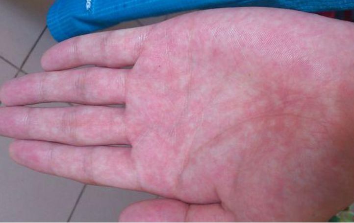 肝脏|无论男女，如果手上没有这3个“特征”，恭喜你，肝脏还很健康！