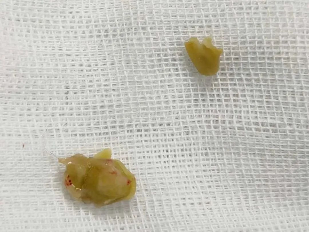 暗网@杭州64岁大伯发热不退、剧烈咳嗽!原因竟和7天前吃下的这道“时令菜”有关!