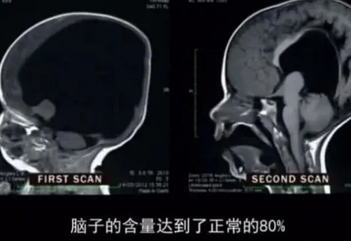 『』世界上唯一没有“大脑”的男孩，脑袋被98%的血充斥，现状如何了？