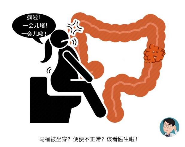 直肠癌@直肠癌是拖出来的,大便四个信号早就提醒,可惜很多人不注意