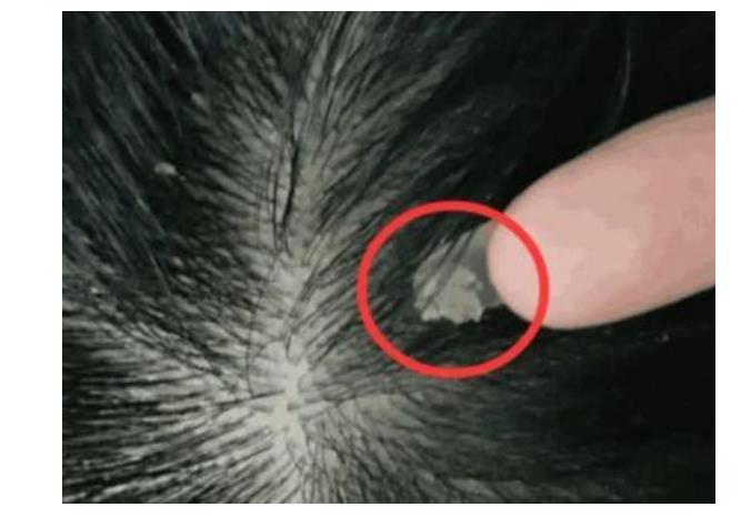 【】总感觉头皮发痒,抓一下手指甲里都是白泥?今天就给大家科普一下!