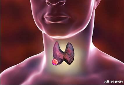 甲状腺结节▲为何甲状腺结节越来越多？提醒：3件事或是“催化剂”，趁早改掉