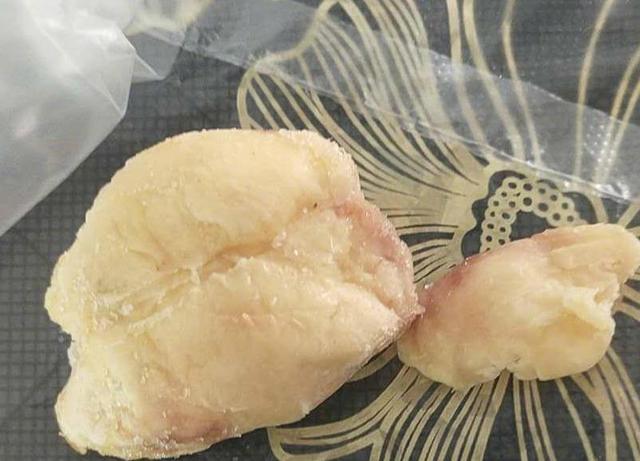 [桂林]10岁学生校内吃馒头噎住，送医后死亡，家长怒了：老师为什么不救