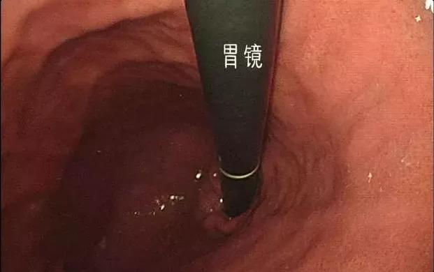 胃癌|我是消化科博士，我父亲却查出了胃癌！不含胃肠镜的体检都是耍流氓