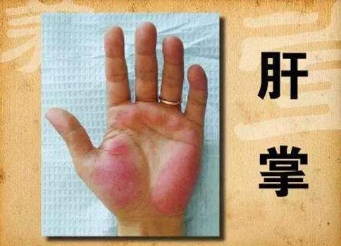 肝癌|42岁男子，确诊肝癌入院，提醒：身上若有\2红、3黄\，早查肝CT