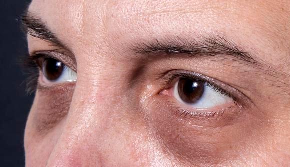 【黑眼圈】肾不好都写在脸上，脸上出现4种状况要注意，3件事不能再做了