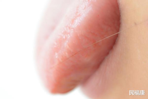 体检：舌头，人体自带的“体检报告”，体内有疾，舌头先知道，别大意了