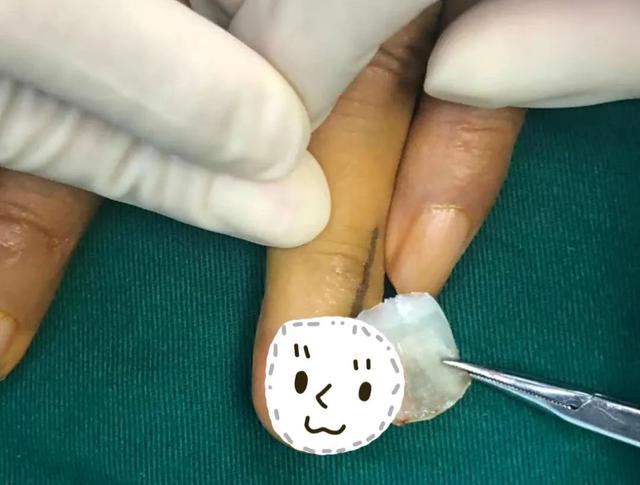 赵忠祥|被鱼刺扎了一下，5年没好变成癌！赵忠祥就因这种癌去世