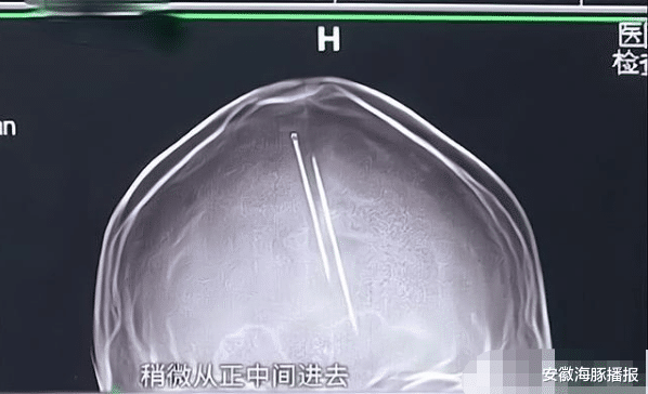 安徽海豚播报|“遇车祸发现头部有两根针”事件新进展，当事人身世曝光