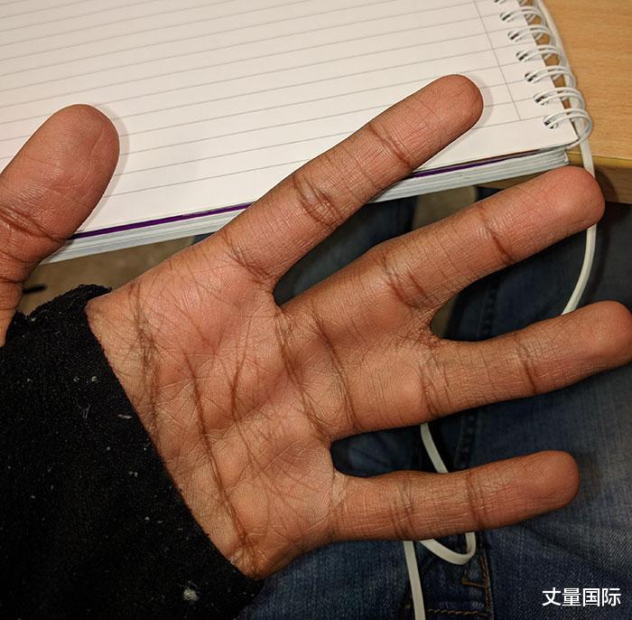 基因|19个“被上帝挑选过”的特殊基因人类，怎么梳都不整齐的头发
