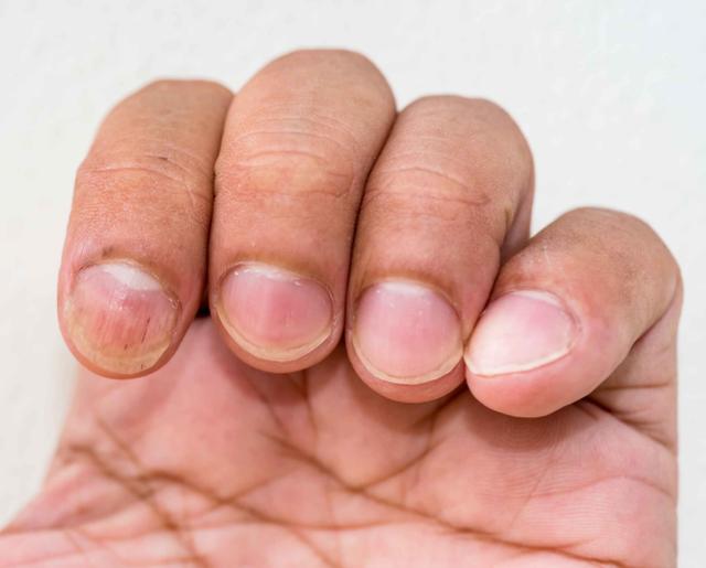 「蜂蜜」手指甲出现“竖纹”，或与这5种疾病发出的预警，你应该知道！